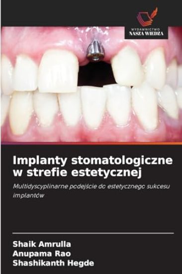 Implanty stomatologiczne w strefie estetycznej