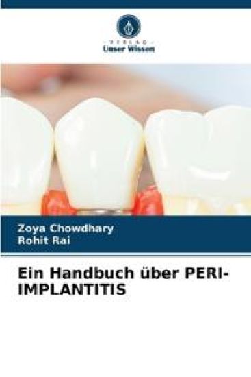 Ein Handbuch über PERI-IMPLANTITIS