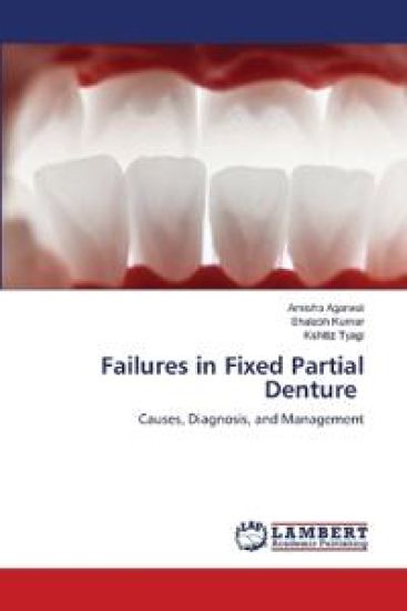 Failures in Fixed Partial Denture
