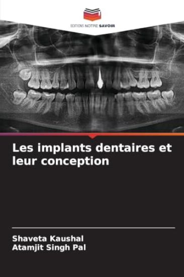 Les implants dentaires et leur conception