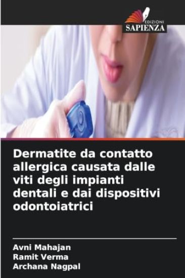 Dermatite da contatto allergica causata dalle viti degli impianti dentali e dai dispositivi odontoiatrici