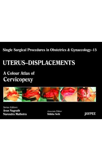 Single Surgical Procedures in Obstetrics and Gynaecology - Volume 15 - UTERUS - DISPLACEMENTS