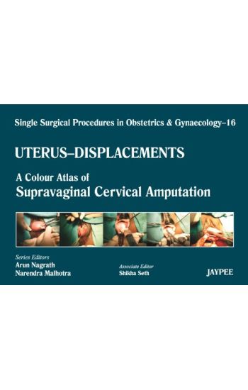 Single Surgical Procedures in Obstetrics and Gynaecology - Volume 16 - UTERUS - DISPLACEMENTS