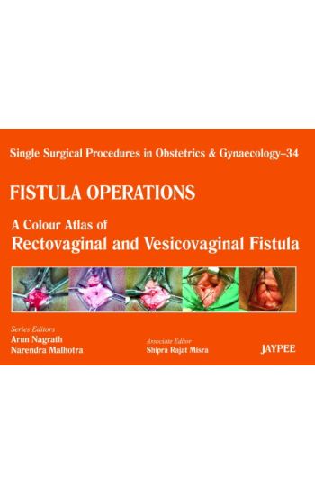 Single Surgical Procedures in Obstetrics and Gynaecology - 34 - Fistula Operations: A Colour Atlas of Rectovaginal and Vesicovaginal Fistula