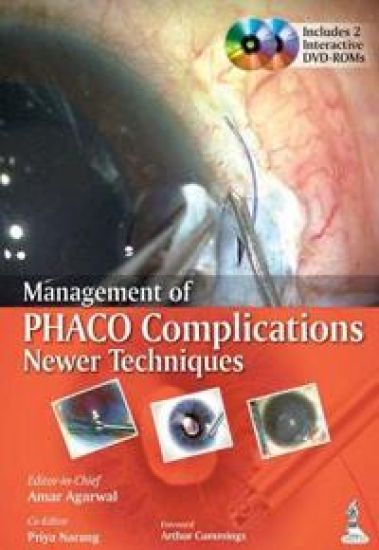 Management of Phaco Complications