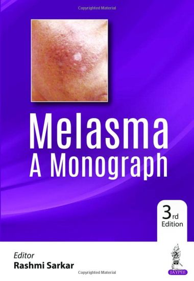 Melasma: A Monograph